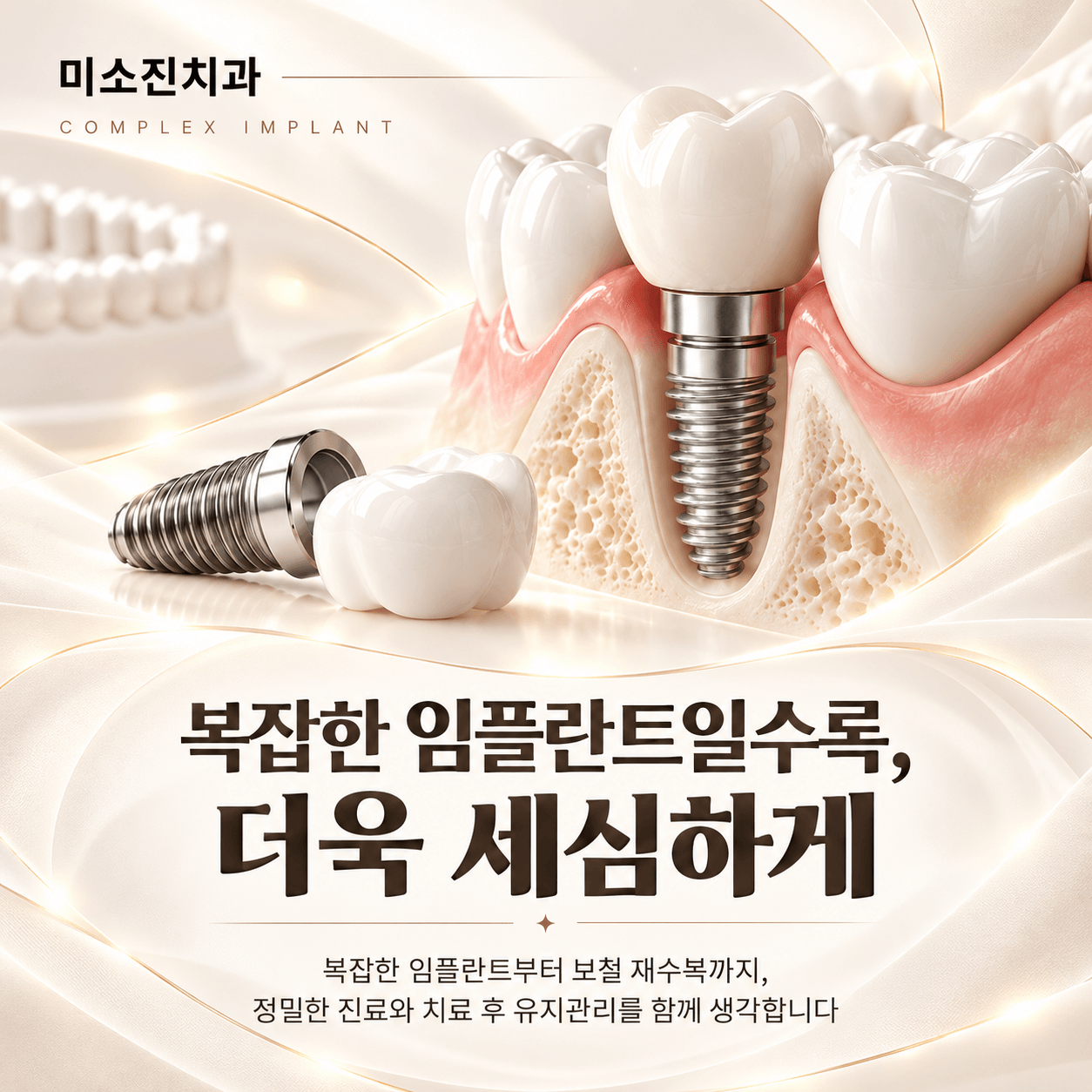 임플란트